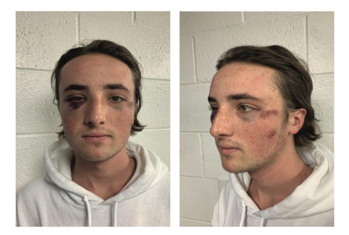 Miami student Ryan McKiernan sported facial injuries in these photos taken the day after the October 3, 2020 brawl.