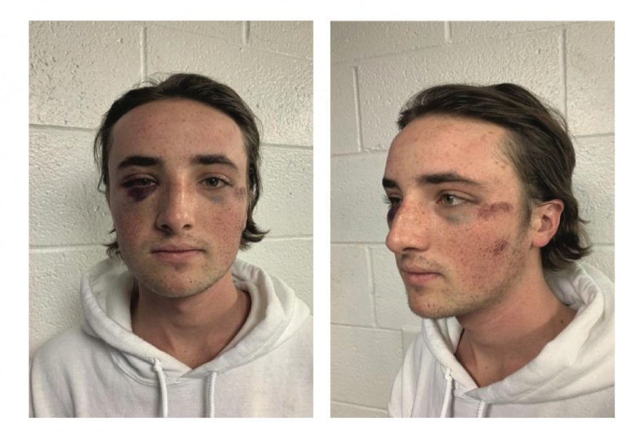 Miami+student+Ryan+McKiernan+sported+facial+injuries+in+these+photos+taken+the+day+after+the+October+3%2C+2020+brawl.